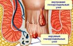 Иссечение анальной трещины: операция и восстановление