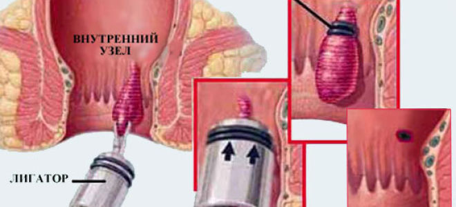 Геморрой — лечение, симптомы, что такое геморрой и как лечить в домашних условиях