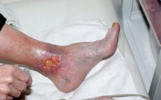 Дерматит: фото на ногах, фото с признаками болезни