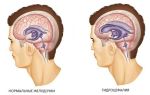 Гидроцефалия головного мозга у взрослых — причины, симптомы, лечение
