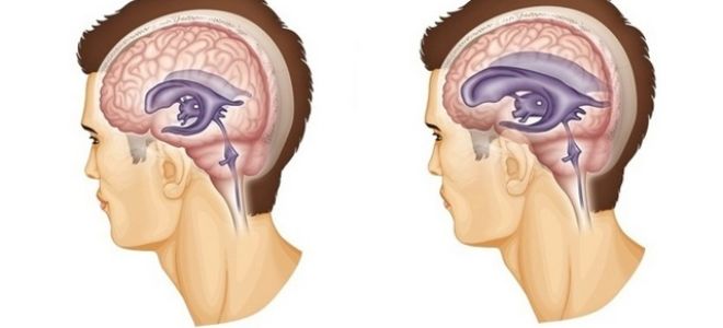 Гидроцефалия головного мозга у взрослых — причины, симптомы, лечение