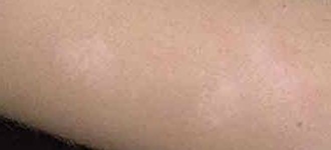 Пятна на теле похожие на лишай не чешутся: фото, что это, как лечить