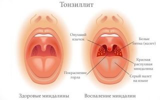 Как проявляется и лечится кандидоз миндалин?