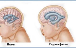 Увеличение желудочков головного мозга у новорожденных