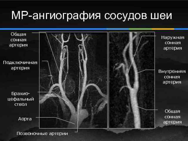 Ангиография сосудов головного мозга и артерий (церебральная), что это такое