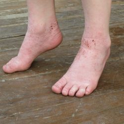 Псориаз на ногах: фото, симптомы и лечение