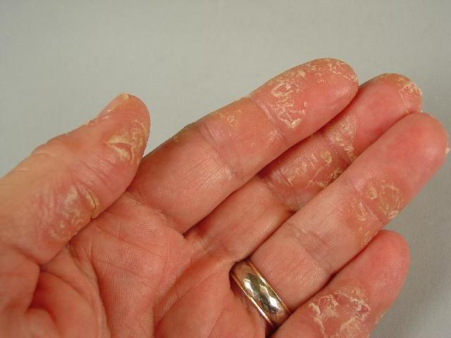 Лечение экземы на руках (пальцах) народными средствами, мазями и кремами