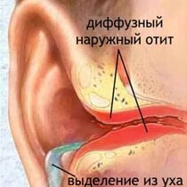 Отит среднего уха - симптомы и лечение у взрослых, как лечить воспаление уха при наружном, гнойном, остром и хроническом отите антибиотиками