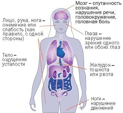 Нарушение мозгового кровообращения: симптомы и лечение