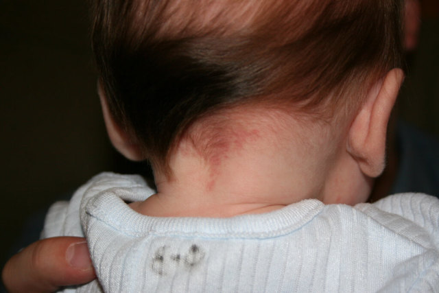 Красные пятна на лице у новорожденного после родов (на затылке, лбу и теле)