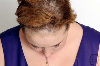 Грибок кожи головы: симптомы и лечение (фото)