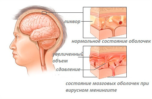 Гидроцефалия головного мозга у взрослых - причины, симптомы, лечение