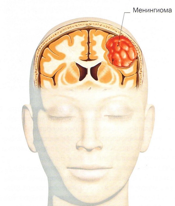 Опухоли головного мозга - причины, симптомы, диагностика и лечение