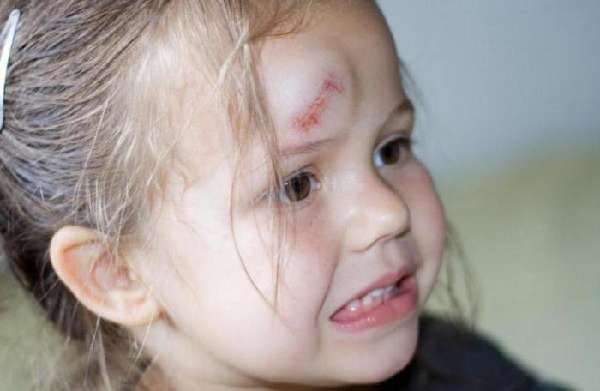 Самые частые причины травм у детей: что делать, если ребенок часто падает и ударяется головой