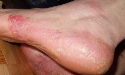 Псориаз на ногах: фото, симптомы и лечение