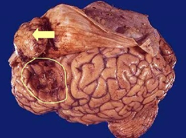 Менингиома головного мозга: прогноз жизни и лечение
