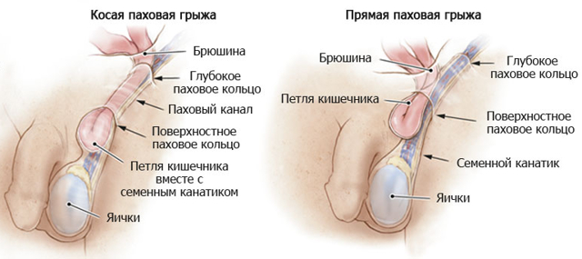 Паховая грыжа у мужчин - симптомы, лечение, операция, удаление. Вестибулярный неврит: симптомы и лечение