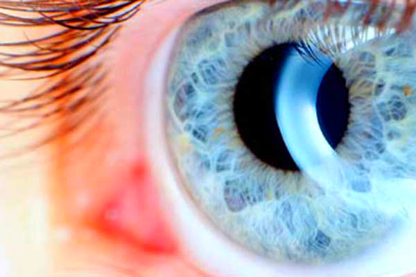 Что такое расфокусировка зрения: причины и лечение