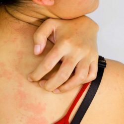 Плоский лишай (красный дерматит): самое эффективное лечение и методы избавления от болезни