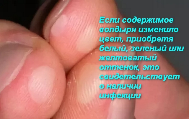 Пузырьки на пальцах рук народное лечение