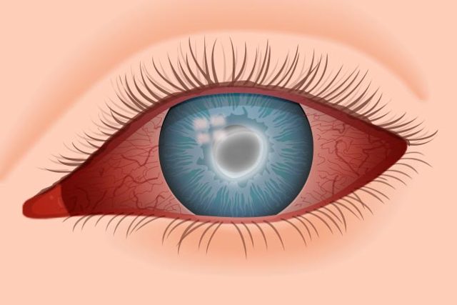 Симптомы боли в глазу при движении глазного яблока