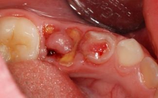 Пульпит зуба: что это такое, симптомы, методы лечения, осложнения