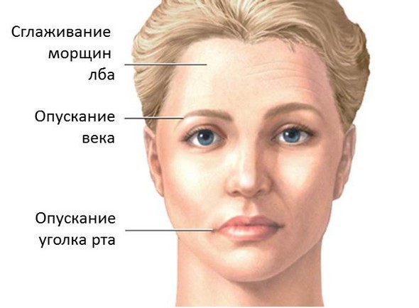Парез лицевого нерва - причины, симптомы и лечение