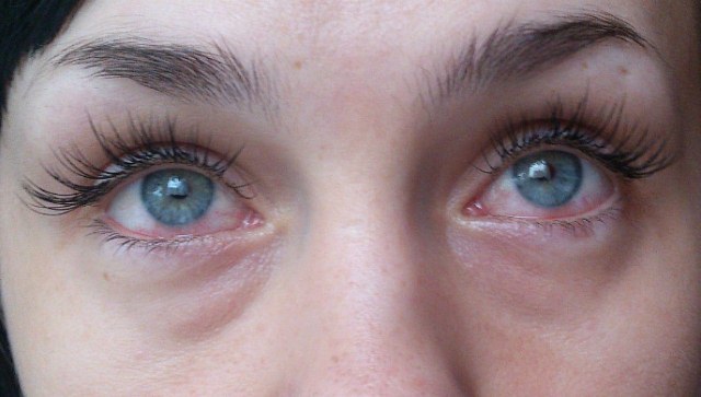 Болят глаза после наращивания ресниц: симптомы (покраснели, чешутся, гноятся, опухли, воспалились, больно моргать), причины, лечение, рекомендации после процедуры