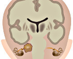 Невринома слухового нерва: симптомы, лечение и удаление