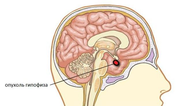 Симптомы опухоли гипофиза: лечение, причины, признаки рака мозга