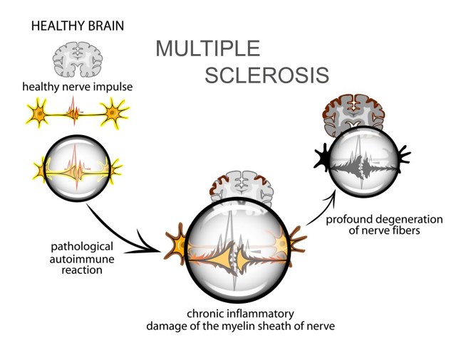 Рассеянный склероз: признаки и симптомы, формы, фазы течения РС