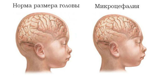 Микроцефалия у детей, причины возникновения и симптомы - Неврология