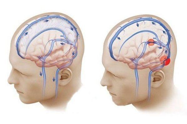 Спазм сосудов головного мозга: симптомы, методы лечения, профилактика