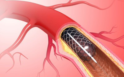 Диета после стентирования коронарных сосудов сердца и инфаркта миокарда: правильное питание и примерное меню