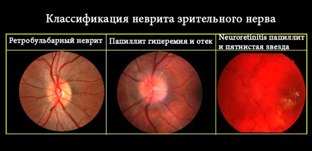 Неврит зрительного нерва: симптомы и лечение воспаления глазного