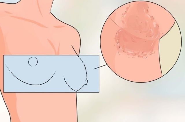 Причины покраснения на грудине у женщины, между грудными железами, около или вокруг сосков