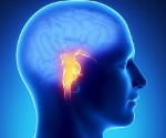 Ишемический инсульт ствола головного мозга (стволовой инсульт): причины, симптомы, прогноз и последствия