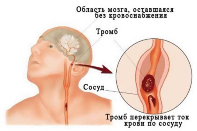 Тромб в голове симптомы и лечение