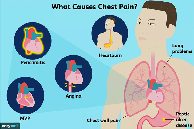 Причина болей в грудной клетке: невралгия или сердце?