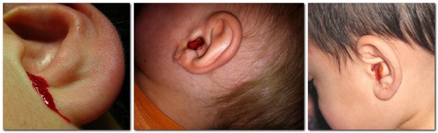 Пошла кровь их уха: причины кровотечения, и лечение домашними средствами, первая помощь при механическом повреждение и появлении новообразования