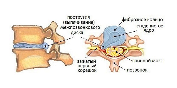 Упражнения при шейном остеохондрозе по Бубновскому: особенности выполнения