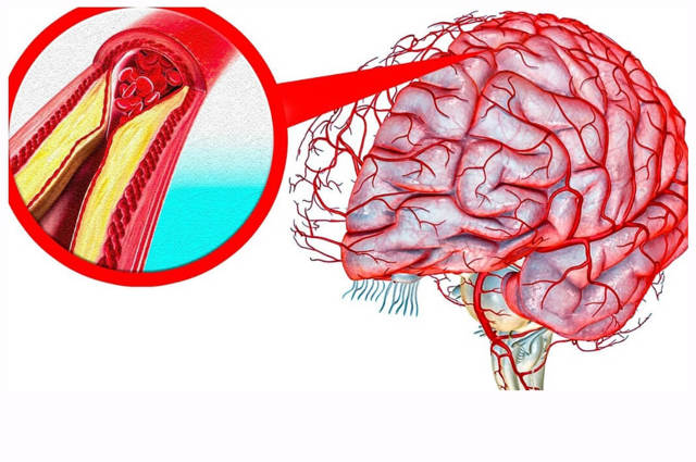 Чистка сосудов головного мозга народными средствами
