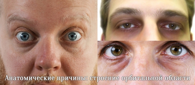 Темные круги и синяки под глазами: главные причины появления