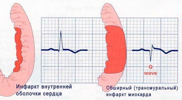 Последствия инфаркта у мужчин: причины, лечение