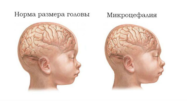 Микроцефалия у детей, симптомы и продолжительность жизни