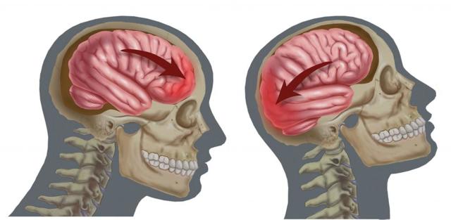 Субдуральная гематома головного мозга: последствия, симптомы, лечение