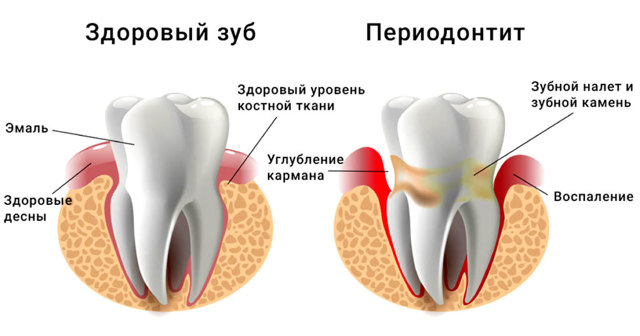Болит зуб мудрости - лечить или удалять