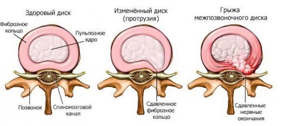 Болит шея с левой стороны: причины и лечение боли слева