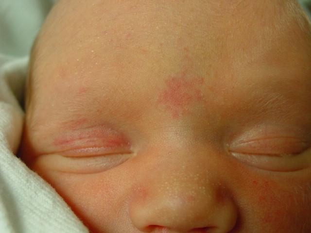 Красные пятна на лице у новорожденного после родов (на затылке, лбу и теле)