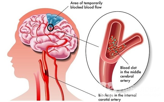 Атеросклероз сосудов головного мозга – симптомы, лечение, диета